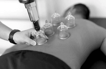 Ventouse cupping therapie avec un kiné du sport à paris