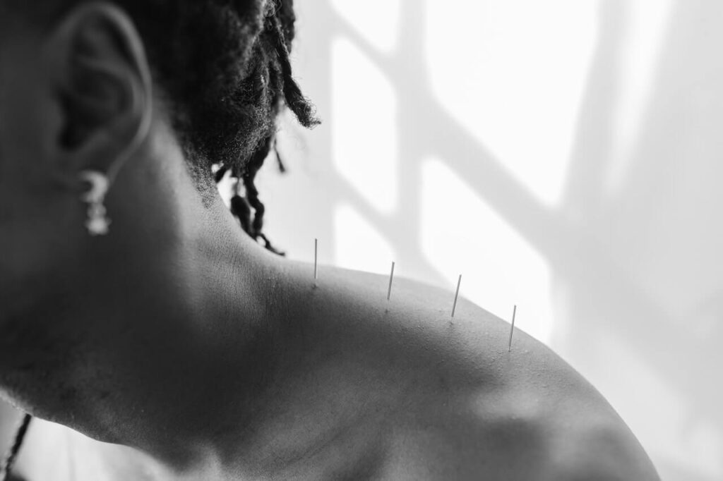 dry needling muscle trapeze supérieur avec un kiné du sport à paris