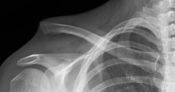 radio entorse acromio claviculaire