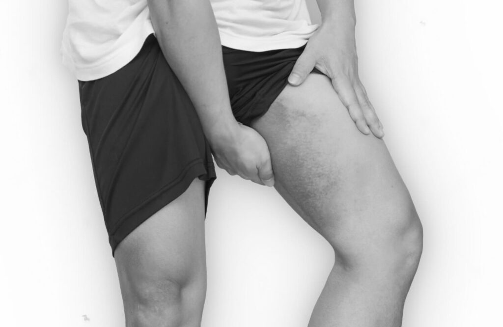 Traitement Contusion Musculaire - CAREA Paris