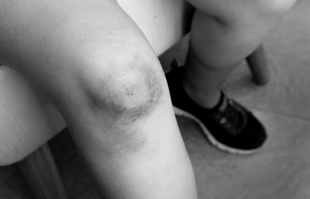 Contusion osseuse genou suite à un traumatisme en sport