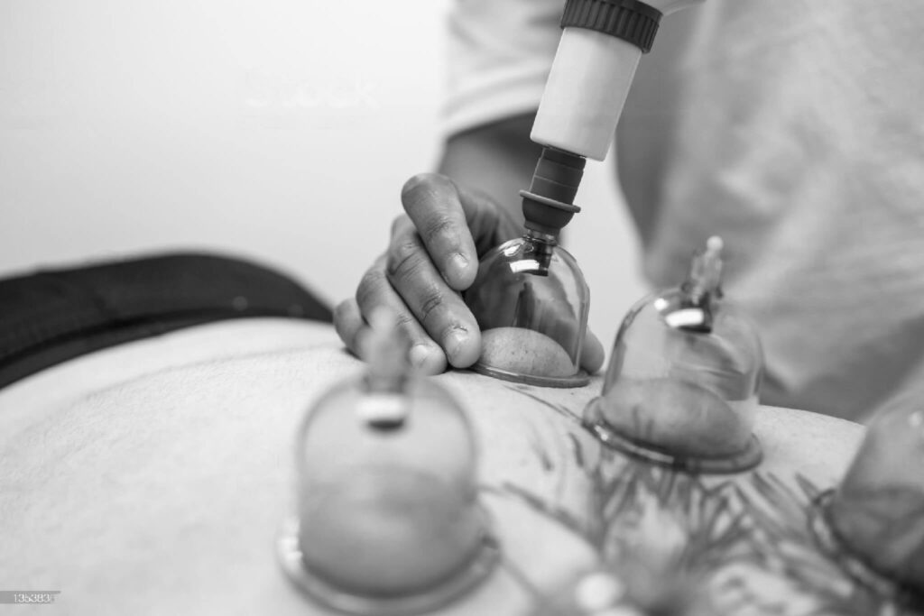 ventousothérapie cupping thérapie hijama bienfaits cabinet kiné du sport à paris CAREA