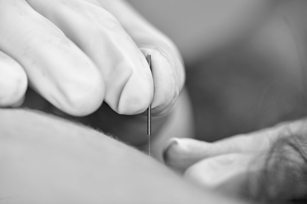 Dry needling kiné