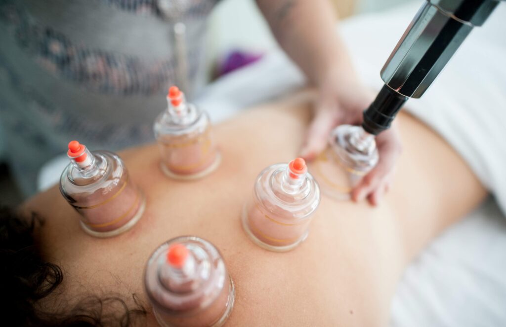 cupping thérapie récupération sportive avec ventouses sur le dos